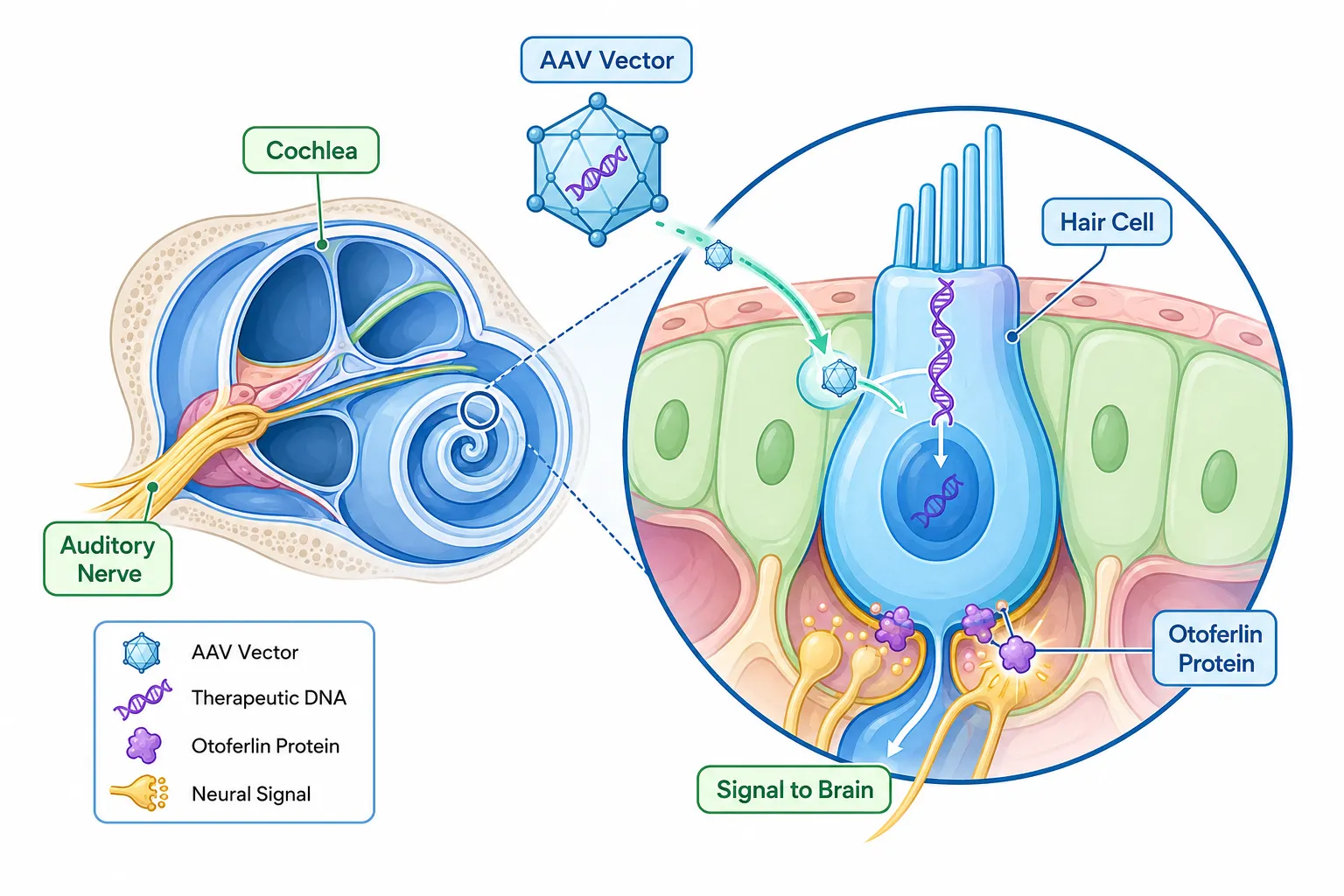 What Is Gene Therapy for Childhood Deafness and How Does It Work?